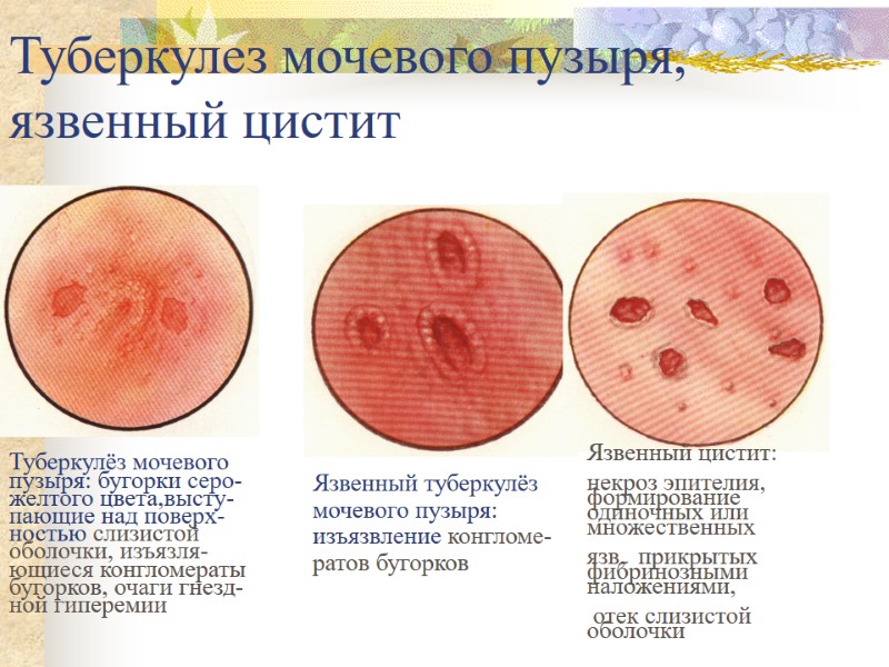 Туберкулез мочевого пузыря, язвенный цистит Туберкулёз мочевого пузыря: бугорки серо- желтого цвета,высту- пающие над